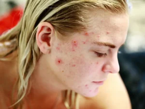 Acne na mulher adulta: Entenda as causas e descubra como tratar de forma segura e eficaz.