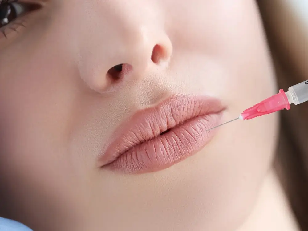 Aplicação de bioestimulador de colágeno em tratamento estético facial após os 40 anos